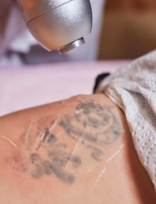 Introducing Laser Tattoo Removal! | Dr Monica Scheel Dermatology,  Kailua-Kona, HI